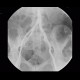 Soft tissue calcifications: AG - Angiography